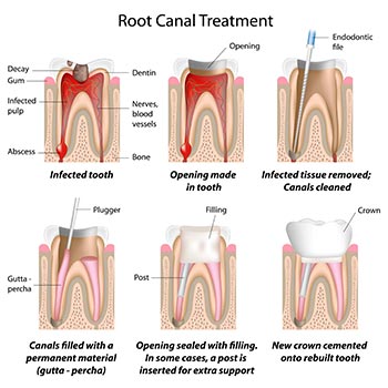 root treatment