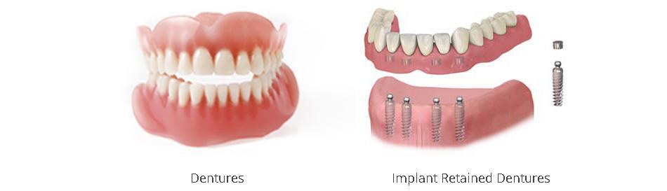 Dentures define