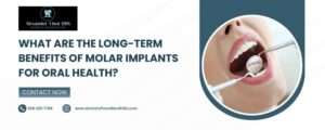 What Are The Long-Term Benefits Of Molar Implants For Oral Health