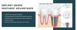 Implant-based dentures' advantages