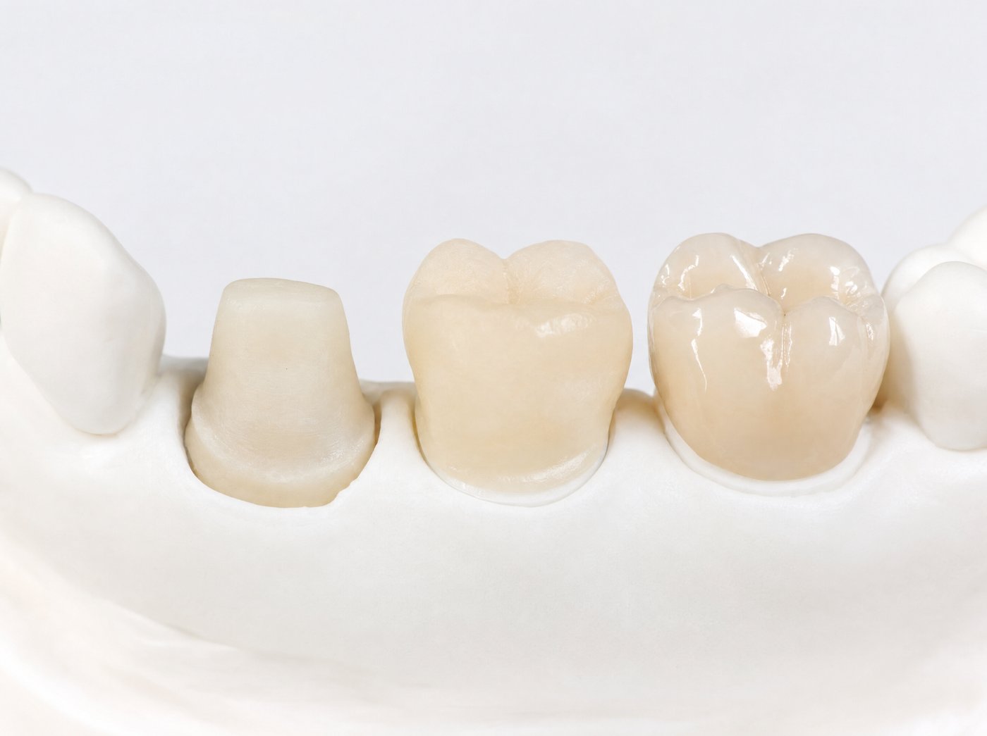 Prepared tooth, temporary crown, and final ceramic crown shown side by side on a dental model